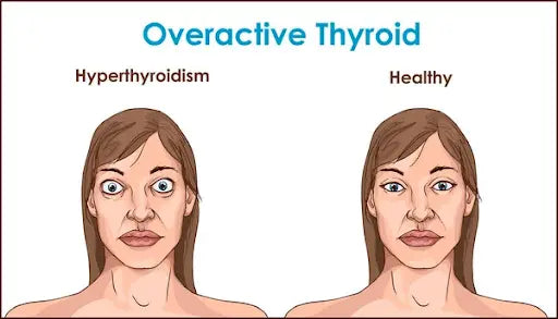 Thyroid and excessive sweating