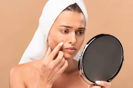 benzoyl peroxide vs salicylic acid for acne